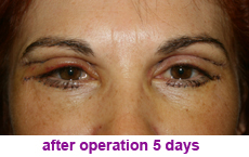 plastic-surgery-blepharoplasty